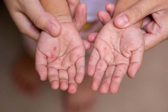 România, responsabilă pentru 77,8% din cazurile de rujeolă din UE